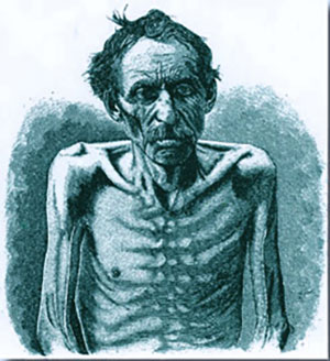 Historische Zeichnung eines bereits abgemagerten Tuberkulose-Patienten Copyright: unbek.