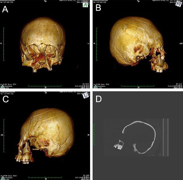 CT-Scans des Turmschädels. Copyright/Quelle: M. Kavka / Pinhasi, Novak et al., 2019