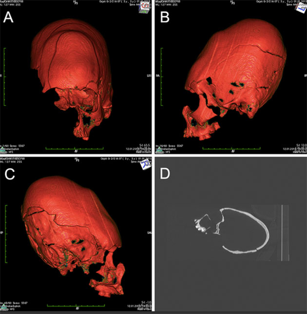 CT-Scan-Rekonstruktion des Langschädels aus der Grabgrube von Hermanov Vinograd. Copyright/Quelle: M. Kavka / Pinhasi, Novak et al., 2019