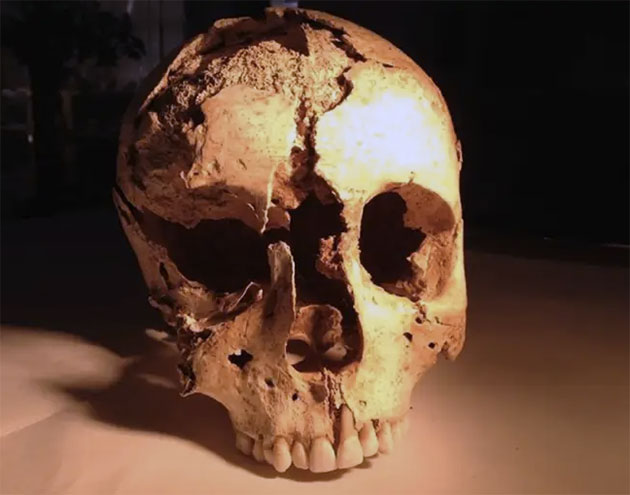 Der Schädel einer vor 2000 Jahren vermutlich an den Folgen von Zöliakie im Alter von 18-20 Jahren verstorbenen Frau. Copyright: Angelo Gismondi u. Alessia D’Agostino et al. / Archaeological and Anthropological Sciences, 2020