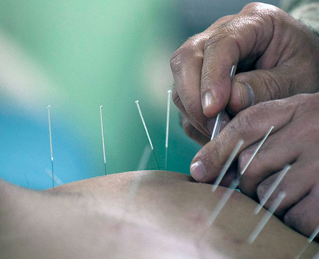 Symbolbild: Akupunktur. Copyright: Gemeinfrei