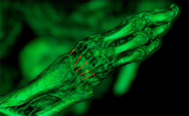 Die CT-Scans der Mumie Maria weisen selbst für Laien deutlich erkennbar fünf Sehnenstränge bzw. deren Reste an Marias Hand aus. (Standbild aus dem folgenden zweiten Video).Quelle: Dr. J. Benoit / Kanal: Luca. (Youtube)